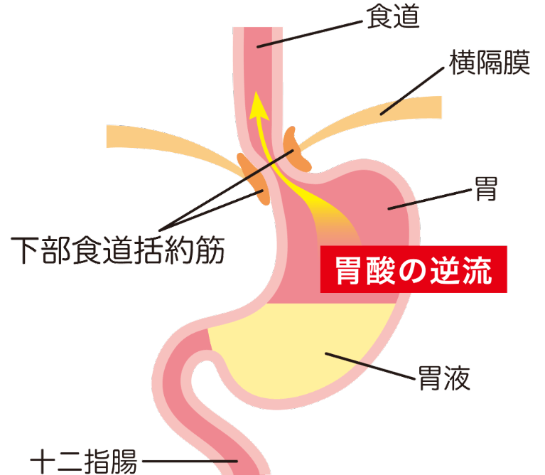 逆流性食道炎の原因